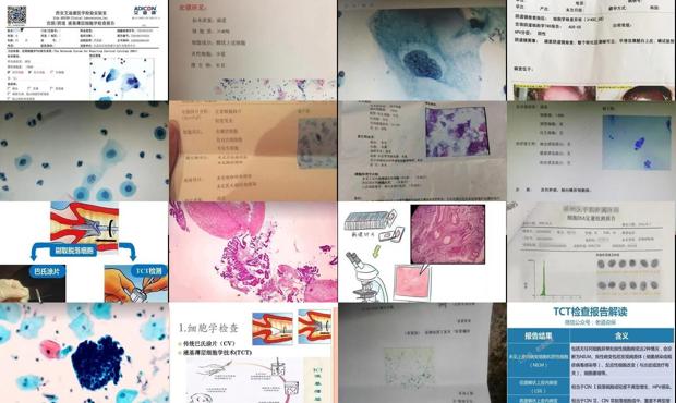 汕头宫颈细胞学检查