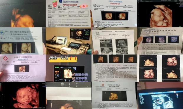 汕头几周做四维
