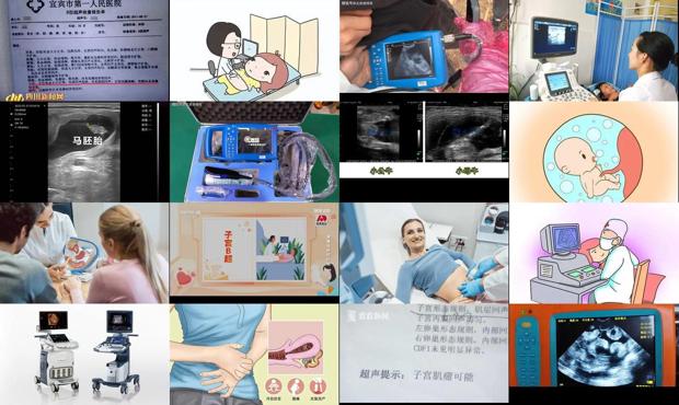 汕头b超检查子宫