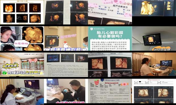 汕头没有做四维彩超怎么办
