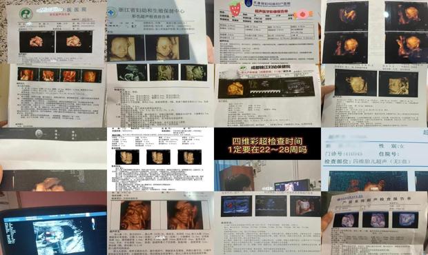 汕头多少周可以做四维