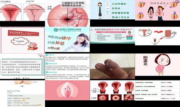 汕头阴道炎会导致不孕吗