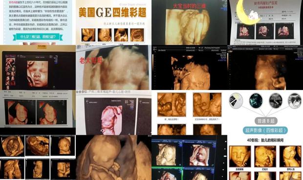 汕头三维跟四维彩超有什么区别
