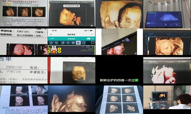 汕头孕22周四维彩超