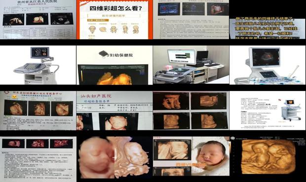汕头四维彩超有什么好处