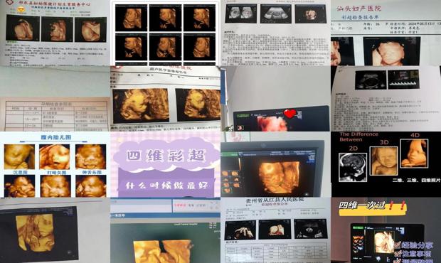 汕头几个月做四维彩超