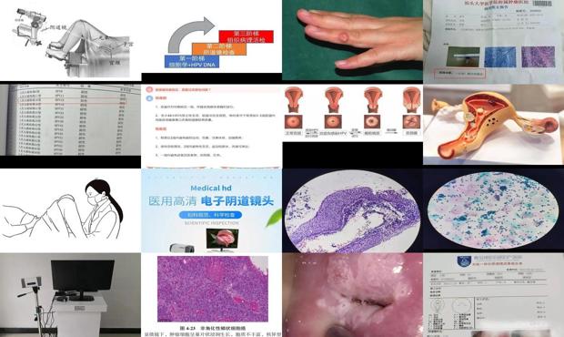 汕头阴道镜检查要多少钱