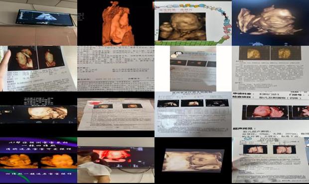 汕头啥是四维彩超
